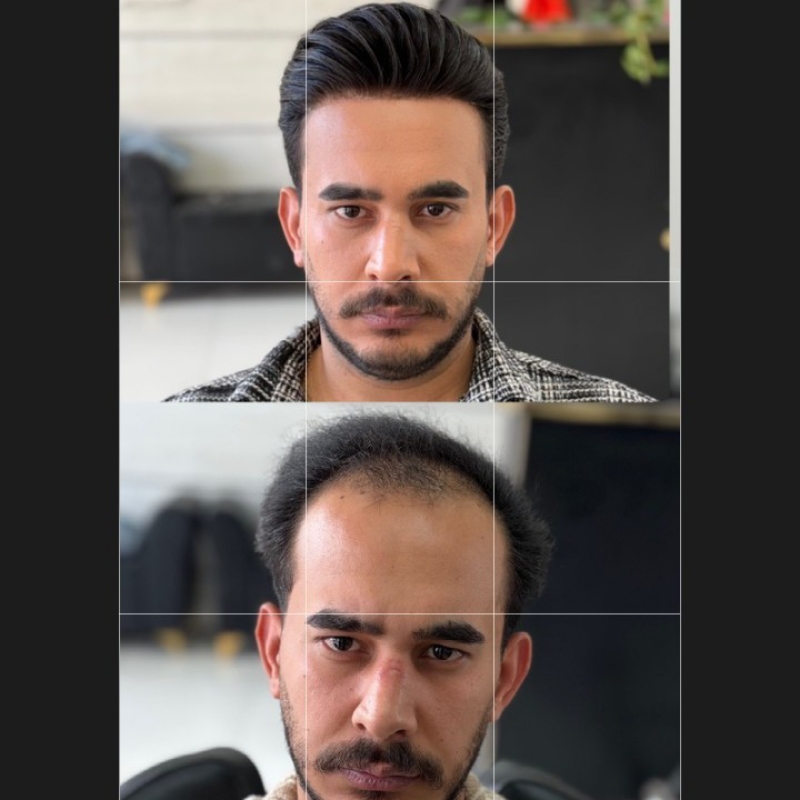 نصب پروتز مو طبیعی برای داماد و مصارف همیشگی