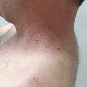برداشت خال و زگیل 50%تخفیف